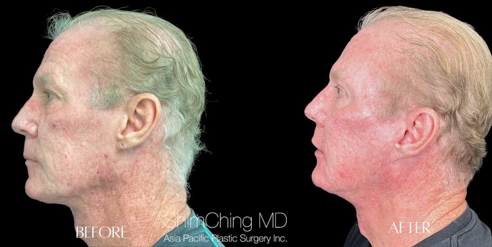 Facelift Before & After Gallery - Patient 147721628 - Image 2