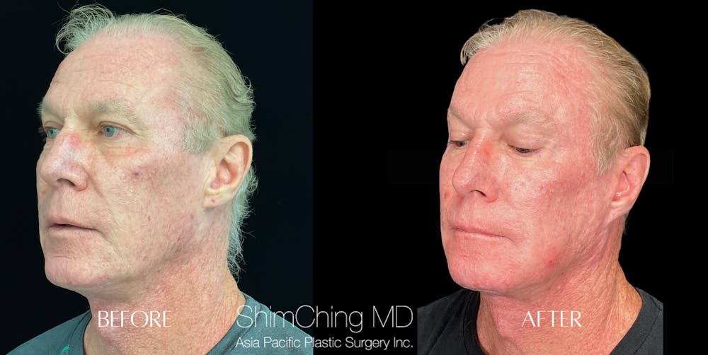 Facelift Before & After Gallery - Patient 147721628 - Image 3