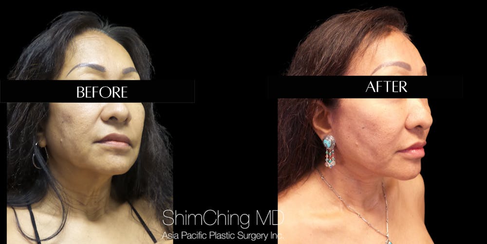 Facelift Before & After Gallery - Patient 147721643 - Image 2