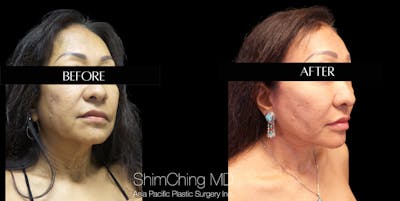 Facelift Before & After Gallery - Patient 147721643 - Image 2