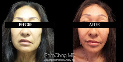Facelift Before & After Gallery - Patient 147721643 - Image 1