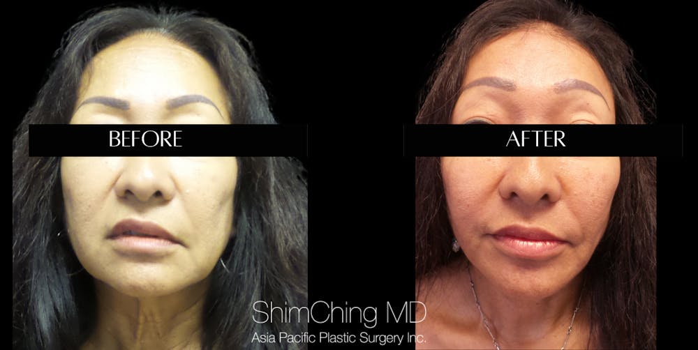 Facelift Before & After Gallery - Patient 147721643 - Image 1