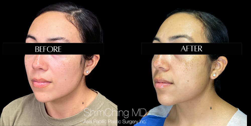 Buccal Fat Removal Before & After Gallery - Patient 147721649 - Image 2