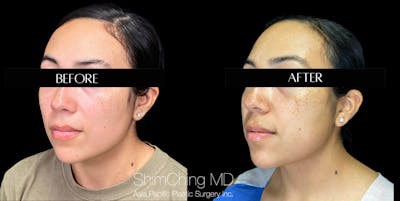 Buccal Fat Removal Before & After Gallery - Patient 147721649 - Image 2