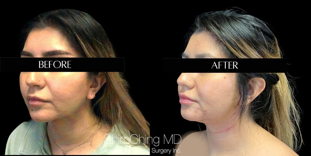 Buccal Fat Removal Before & After Gallery - Patient 147721653 - Image 2