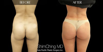 Brazilian Butt Lift Before & After Gallery - Patient 147775637 - Image 1