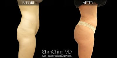 Brazilian Butt Lift Before & After Gallery - Patient 147775637 - Image 4