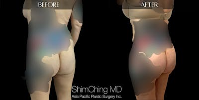 Brazilian Butt Lift Before & After Gallery - Patient 147775705 - Image 2