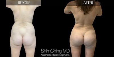 Brazilian Butt Lift Before & After Gallery - Patient 148037581 - Image 1