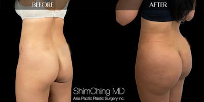 Brazilian Butt Lift Before & After Gallery - Patient 148037725 - Image 1