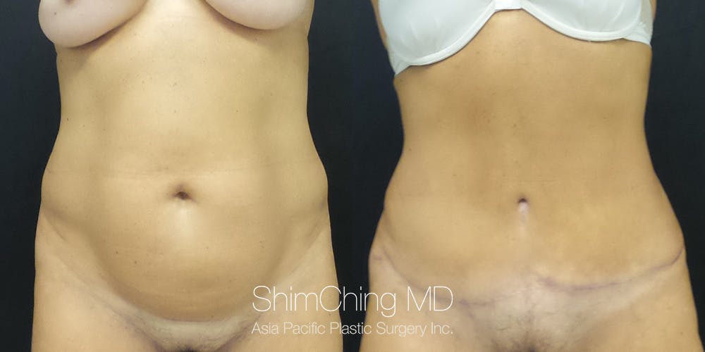 Tummy Tuck Before & After Gallery - Patient 148352025 - Image 1