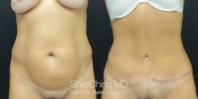 Tummy Tuck Before & After Gallery - Patient 148352025 - Image 1