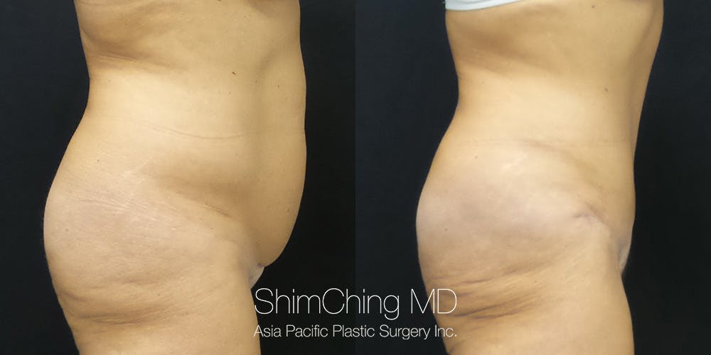 Tummy Tuck Before & After Gallery - Patient 148352025 - Image 3