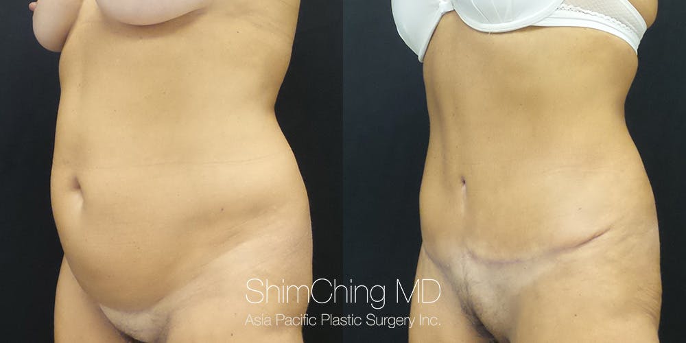 Tummy Tuck Before & After Gallery - Patient 148352025 - Image 4