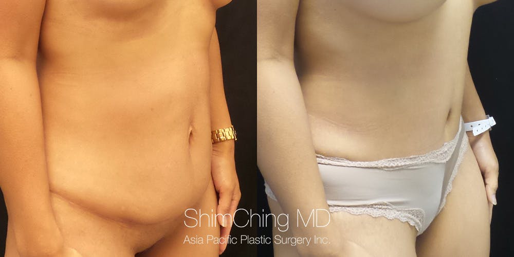Tummy Tuck Before & After Gallery - Patient 148352073 - Image 2