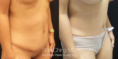 Tummy Tuck Before & After Gallery - Patient 148352073 - Image 2