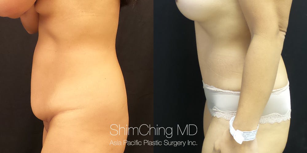 Tummy Tuck Before & After Gallery - Patient 148352073 - Image 3