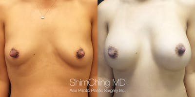 Breast Augmentation Before & After Gallery - Patient 148352109 - Image 1