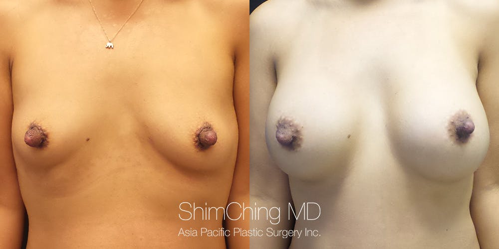 Breast Augmentation Before & After Gallery - Patient 148352109 - Image 1