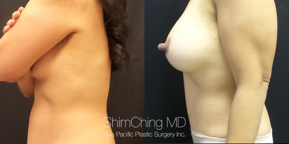 Breast Augmentation Before & After Gallery - Patient 148352109 - Image 3