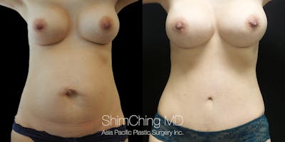 Breast Augmentation Revision Before & After Gallery - Patient 148352115 - Image 1