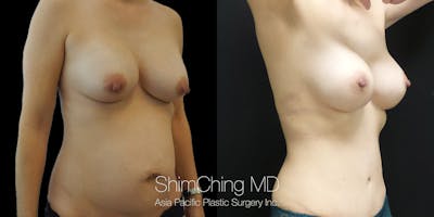Tummy Tuck Before & After Gallery - Patient 148352121 - Image 2