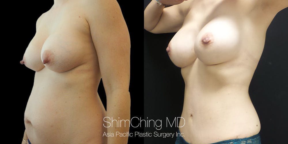 Tummy Tuck Before & After Gallery - Patient 148352121 - Image 3