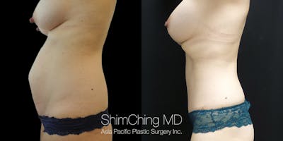 Tummy Tuck Before & After Gallery - Patient 148352121 - Image 4