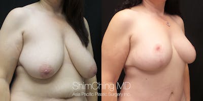 Breast Lift Before & After Gallery - Patient 148352127 - Image 2