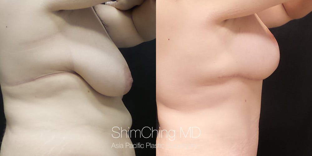 Breast Reduction Before & After Gallery - Patient 177777126 - Image 3