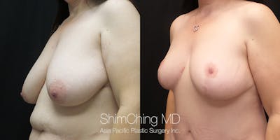 Breast Lift Before & After Gallery - Patient 148352127 - Image 4