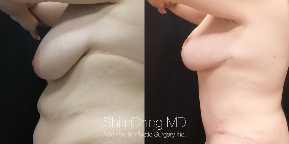 Breast Lift Before & After Gallery - Patient 148352127 - Image 5
