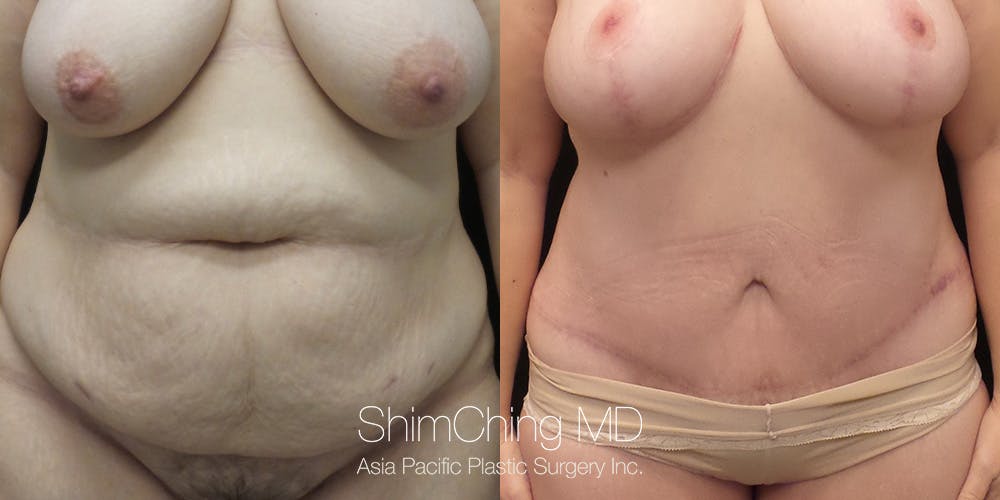 Tummy Tuck Before & After Gallery - Patient 148352154 - Image 1