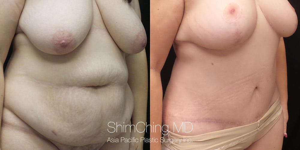 Tummy Tuck Before & After Gallery - Patient 148352154 - Image 2