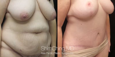Tummy Tuck Before & After Gallery - Patient 148352154 - Image 2