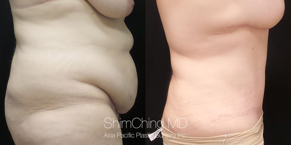 Tummy Tuck Before & After Gallery - Patient 148352154 - Image 3