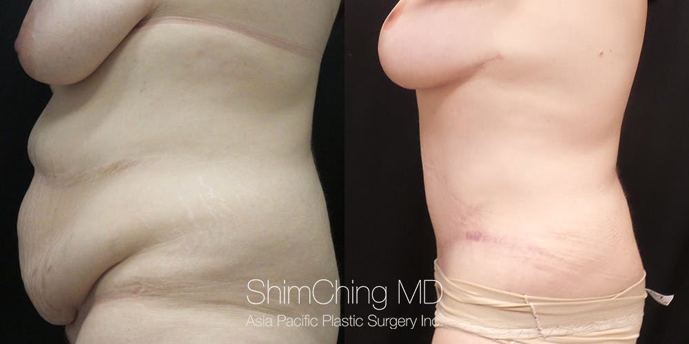 Tummy Tuck Before & After Gallery - Patient 148352154 - Image 5