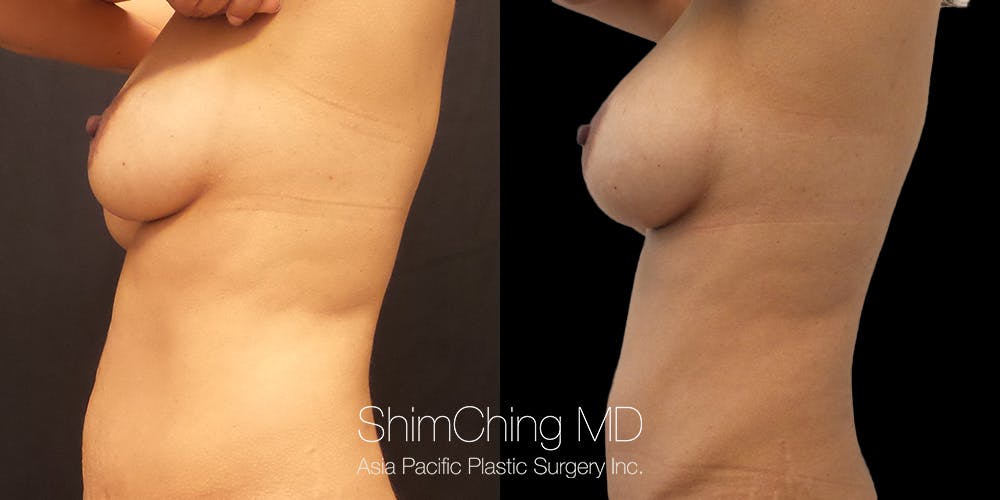 Breast Augmentation Before & After Gallery - Patient 148352164 - Image 3