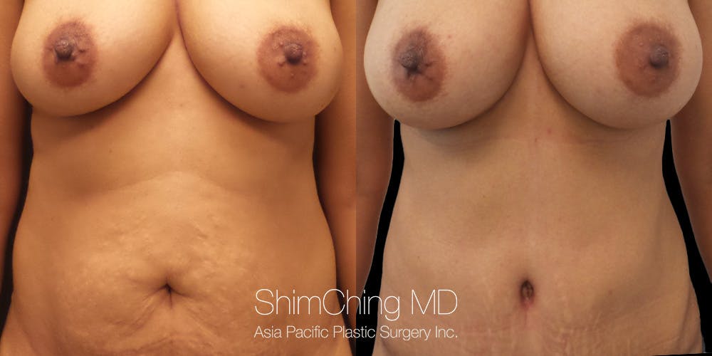 Tummy Tuck Before & After Gallery - Patient 148352186 - Image 1