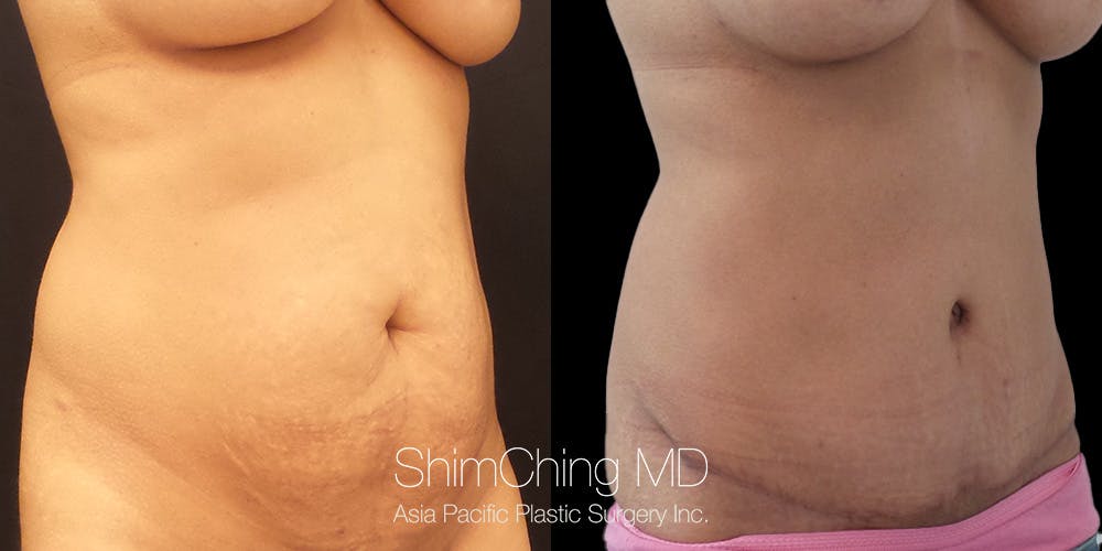 Tummy Tuck Before & After Gallery - Patient 148352186 - Image 2
