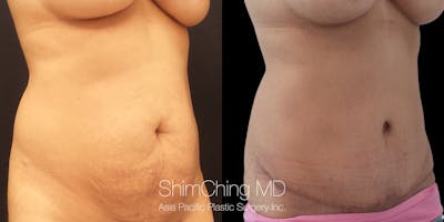 Tummy Tuck Before & After Gallery - Patient 148352186 - Image 2