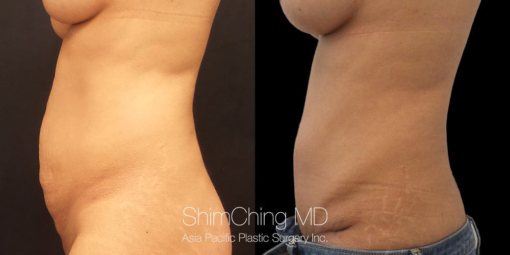 Tummy Tuck Before & After Gallery - Patient 148352186 - Image 3