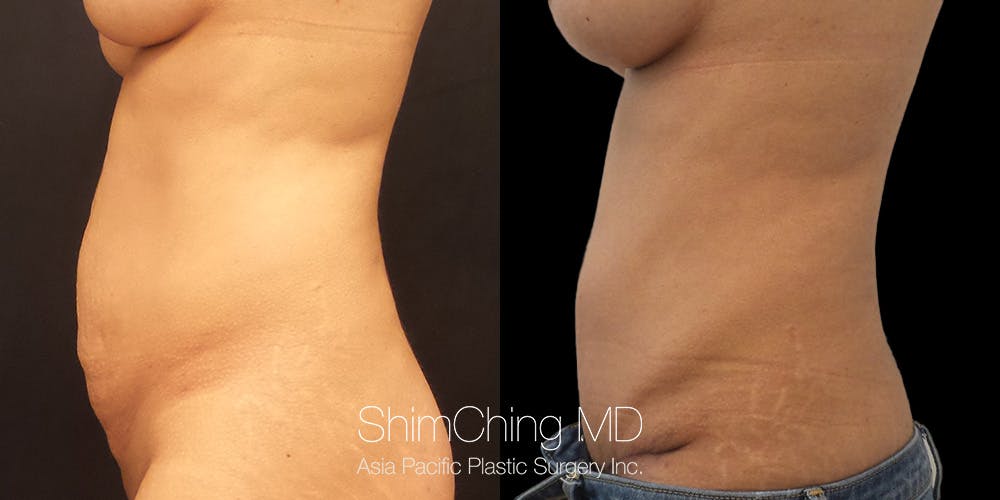 Tummy Tuck Before & After Gallery - Patient 148352186 - Image 3