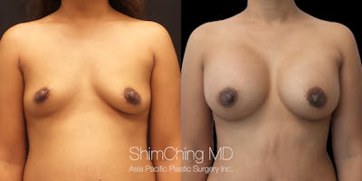 Breast Augmentation Before & After Gallery - Patient 148352201 - Image 1