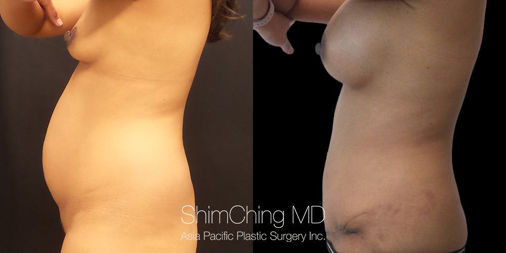 Tummy Tuck Before & After Gallery - Patient 148352212 - Image 2