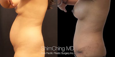 Tummy Tuck Before & After Gallery - Patient 148352212 - Image 2