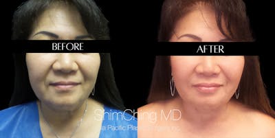 Necklift Before & After Gallery - Patient 147721398 - Image 1