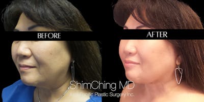 Necklift Before & After Gallery - Patient 147721398 - Image 2