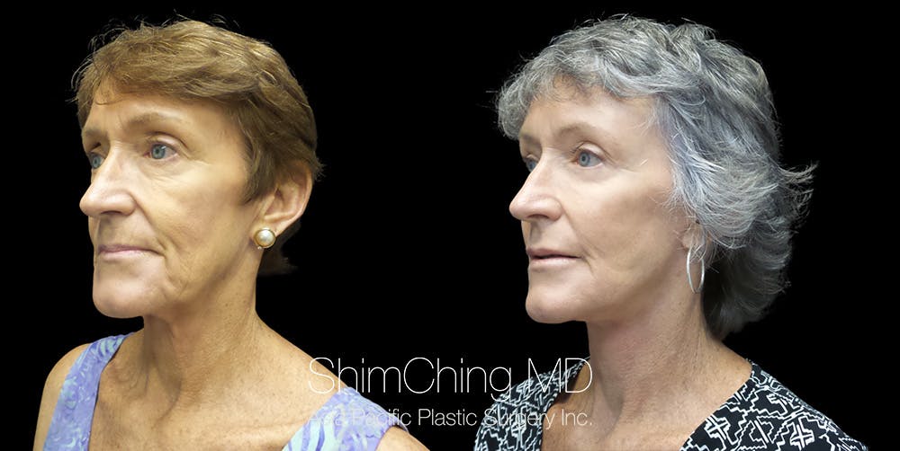 Necklift Before & After Gallery - Patient 55029176 - Image 3