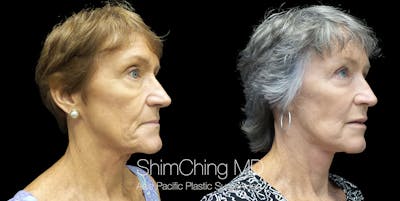 Necklift Before & After Gallery - Patient 55029176 - Image 4